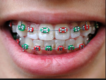 braces san antonio